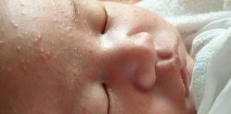 Причины возникновения акне новорожденных: фото, симптомы, действенные методы лечения и профилактика